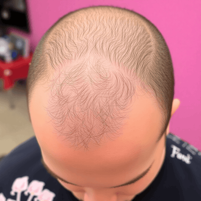 Androgenic Alopecia