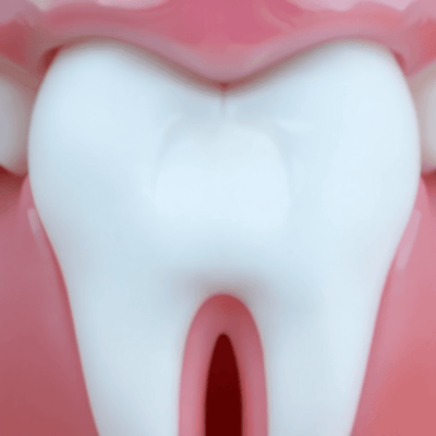 Hydroxyapatite and CPP-ACP for Tooth Remineralization